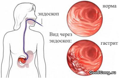Гастрит - лечение и профилактика